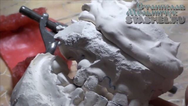 ЗУБНЫЕ ПРОТЕЗЫ. Будем делать чудеса. смотреть онлайн