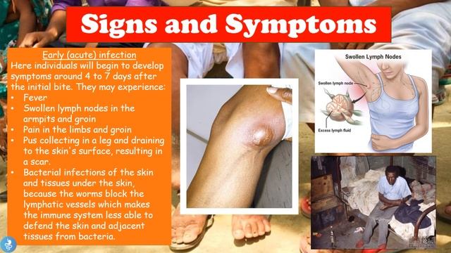Lymphatic Filariasis - (Elephantiasis) смотреть онлайн