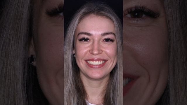 Как работа со скученностью зубов