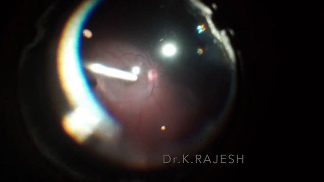 Oil Removal Post RD Sx - Video 63 смотреть онлайн