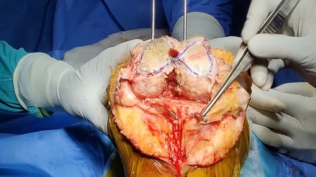 Total Knee Replacement (Step by Step Guide for Beginners) смотреть онлайн