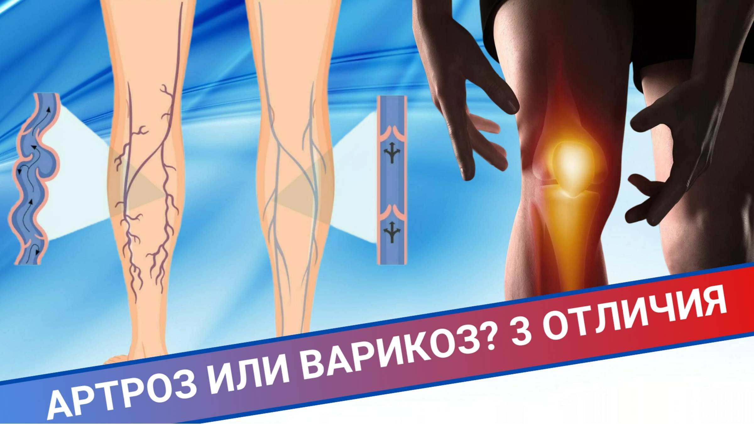 АРТРОЗ ИЛИ ВАРИКОЗ? 3 ОТЛИЧИЯ смотреть онлайн