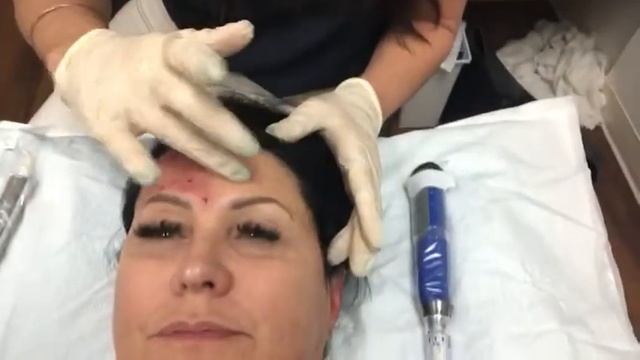 Split Face EXCEED vs SkinPen смотреть онлайн