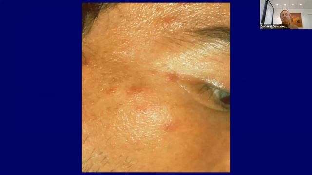 The Role of the Dermatopathologist in the Diagnosis of Infectious Diseases смотреть онлайн