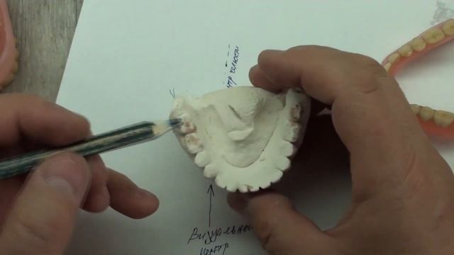 ЗУБНЫЕ ПРОТЕЗЫ. Смещенная вправо нижняя челюсть. смотреть онлайн