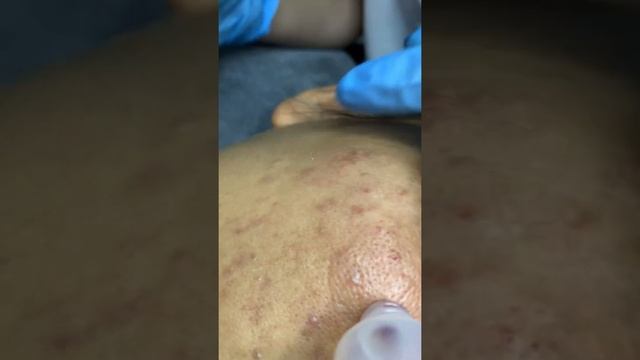 Như thế nào là nặn mụn đúng cách đạt chuẩn spa смотреть онлайн