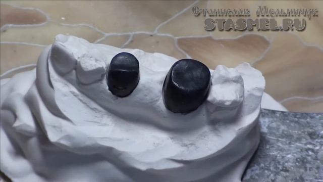 Штампованные коронки. Мост в три единицы. Обработка литка. Фиксация литка липким воском к коронкам. смотреть онлайн