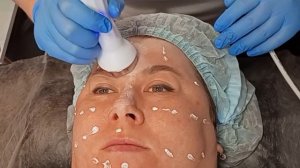 Неинвазивная карбокситерапия и фарфоровая куколка.