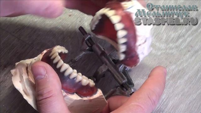 ЗУБНЫЕ ПРОТЕЗЫ. Когда жевательная группа зубов ставится в обратном прикусе. смотреть онлайн