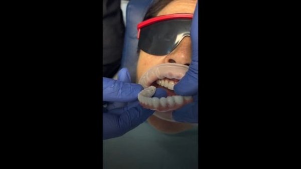 На имплантатах зубки #dentist #dental #dentistry #