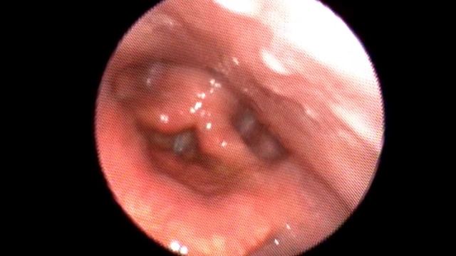 leukoplakia of the vocal cord causing change of voice ( by fiberoptic laryngoscopy ) смотреть онлайн