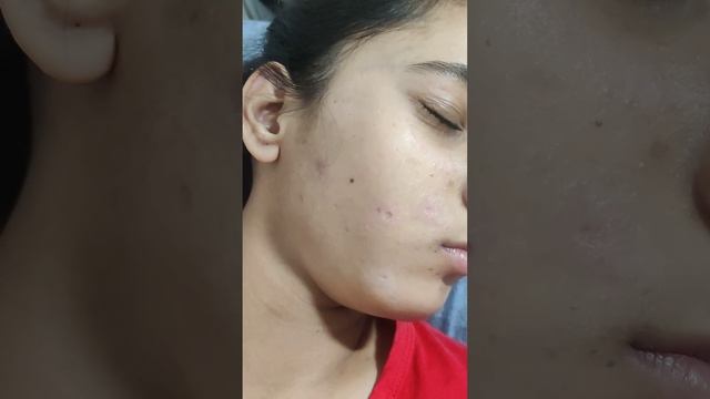 Best Scar Laser Treatment in ZIRAKPUR- Call now at 98769-31601 смотреть онлайн