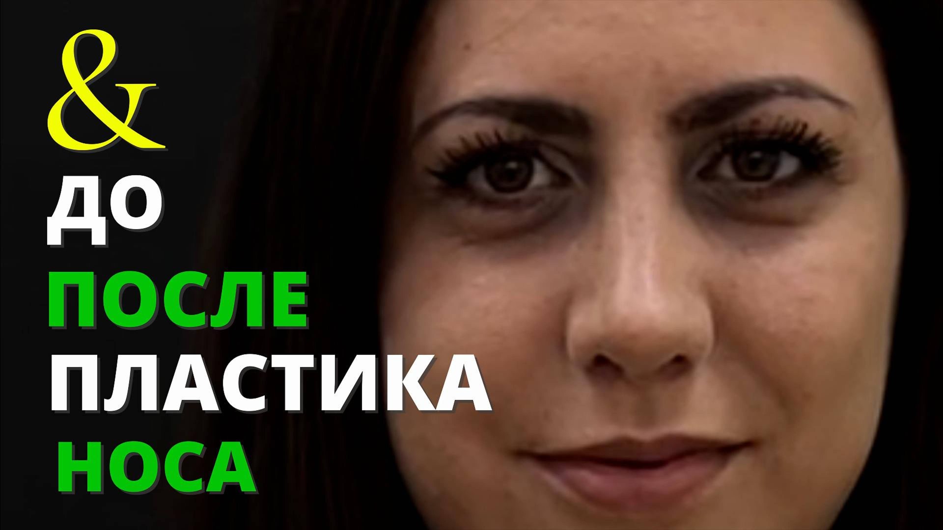 Мечта жизни - ринопластика! смотреть онлайн