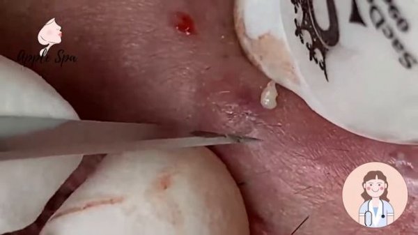 Relax every day with Apple Spa - Squeeze acne blackheads #54