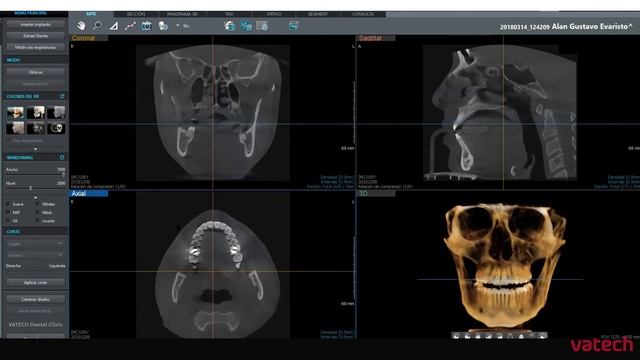 Ez3D-i / MPR смотреть онлайн