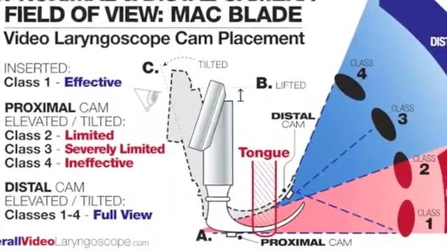 Berall Video Laryngoscope Mac Blade Enthusiast смотреть онлайн