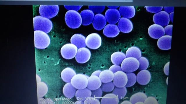 Staphylococcus aureus (infectious) смотреть онлайн