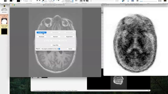 PET MR image Fusion using Horos or Osirix смотреть онлайн