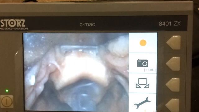 Endotracheal intubation using C-MAC video laryngos смотреть онлайн