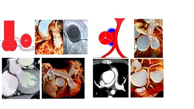 Cardiac CT in Congenital Heart Disease (B. Kelly Han, MD, Valeria Duarte, MD) смотреть онлайн