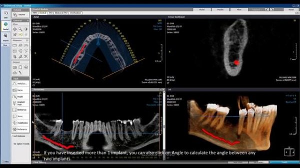 OnDemand3D Dental Implant Planning