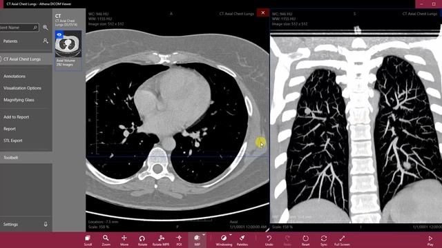 MIP and MinIP - Athena DICOM Viewer смотреть онлайн