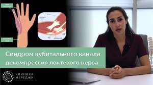 Синдром кубитального канала - туннельная нейропатия локтевого нерва
