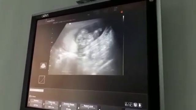 УЗИ 17 недель определение пола смотреть онлайн