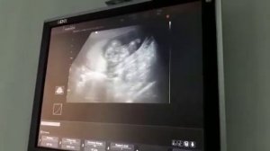 УЗИ 17 недель определение пола