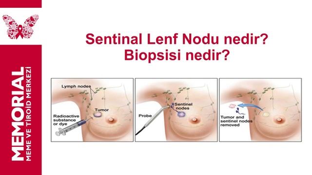 Sentinel Lenf Nodu Nedir? Prof. Dr. Mustafa Özdoğan - Prof. Dr. Alihan Gürkan смотреть онлайн