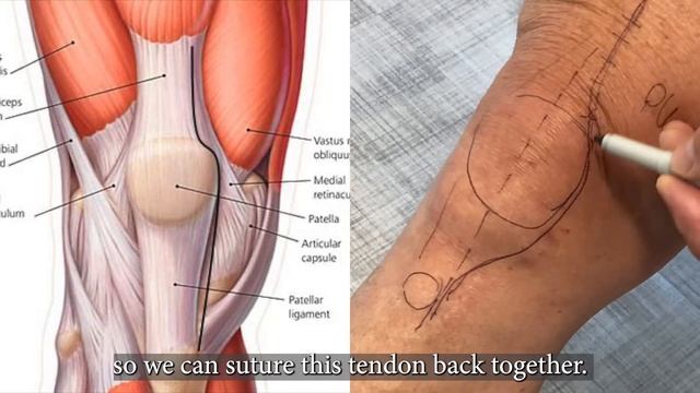 Why Does Dr. Calton use a Stryker Mako Robot for Hip and Knee Replacement? смотреть онлайн