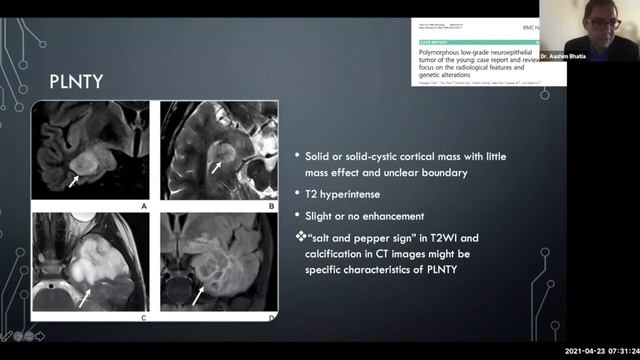 Pediatric Brain Tumors смотреть онлайн