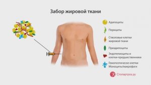 Что такое SVF-терапия?