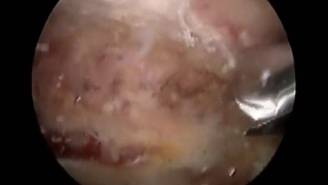 SHOULDER ARTHROSCOPY TREATMENT OF SNAPPING SCAPULA, DR ROBERT RUPP смотреть онлайн