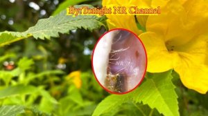 ear wax removal and ear infection || ear wax removal and skin peel
