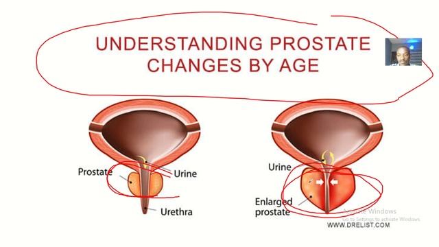 Age changes in the prostate Gland; Normal, Enlarged and benign prostatic hypertrophy смотреть онлайн