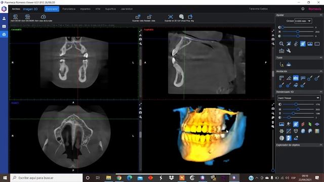 Curso software romexis Centro Radiologico Maxilar смотреть онлайн