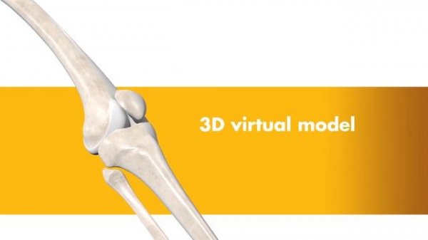 Mako Robotic-Arm Assisted Partial Knee Replacement