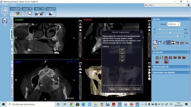 APLICACIÓN DE VISUALIZADOR ROMEXIS PARA CASO DE PATOLOGÍA смотреть онлайн