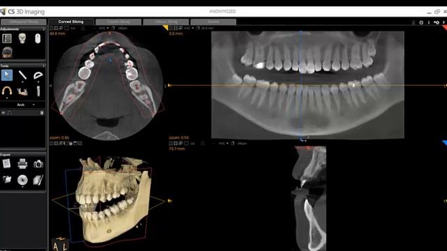 CS 3D imaging software basic tutorial #Carestream смотреть онлайн