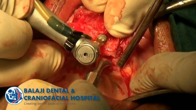 Dental Implants with Maxillary Sinus Lift смотреть онлайн