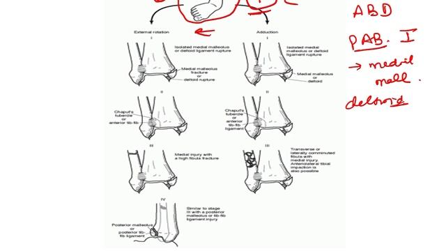 Lauge Hansen Ankle Fracture Classification смотреть онлайн