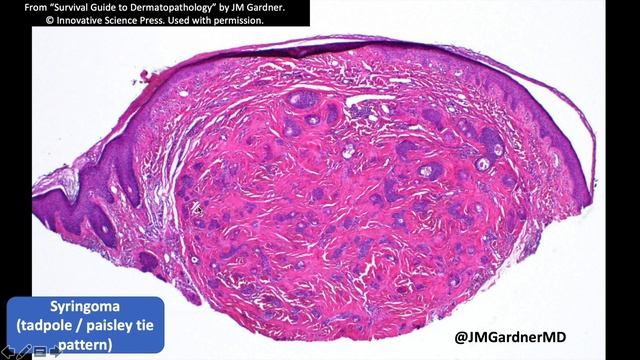 Syringoma: 5-Minute Pathology Pearls (Tadpole / Paisley Tie Pattern Dermpath Dermatology) смотреть онлайн