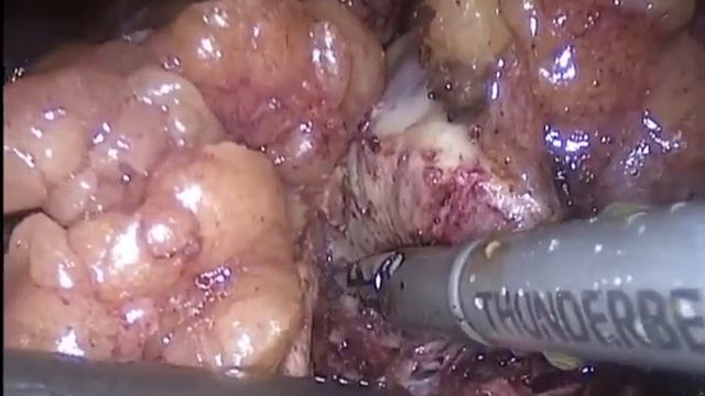 Laparoscopic ischemic resection of the left kidney смотреть онлайн