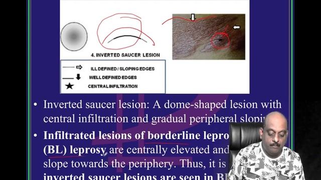 4 PM Quick FMGE 200 MCQs Dermatology Flash Revision for NEET PG 2020 Call 9000868356 смотреть онлайн