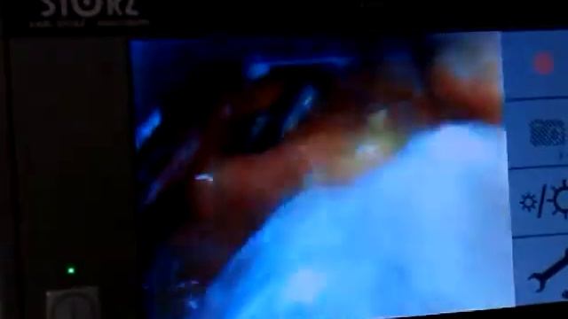 videolaryngoscopy intubation смотреть онлайн