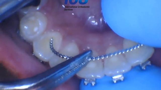 How To Place A Permanent Retainer IOS Ultra Flex / Reliance Ortho FlexTech