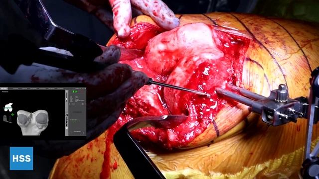 TKA with Stryker MAKO Robot смотреть онлайн