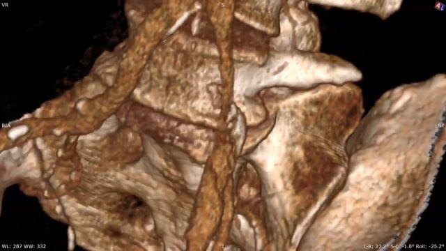 3D VR movie creator in RadiAnt DICOM Viewer смотреть онлайн