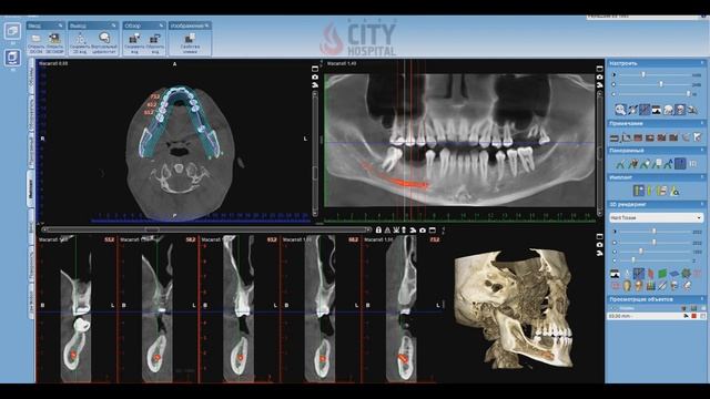 Planmeca Implant Planning In Romexis Viewer